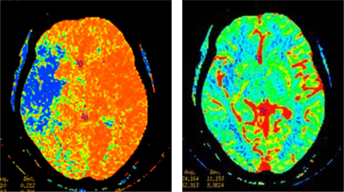 When To Do Ct Perfusion