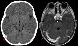 VENOUS THROMBOSIS2